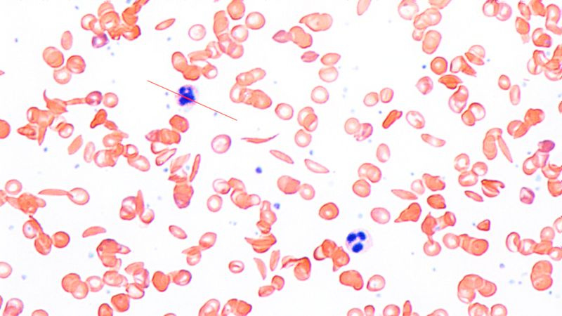 Micrographie de cellules falciformes