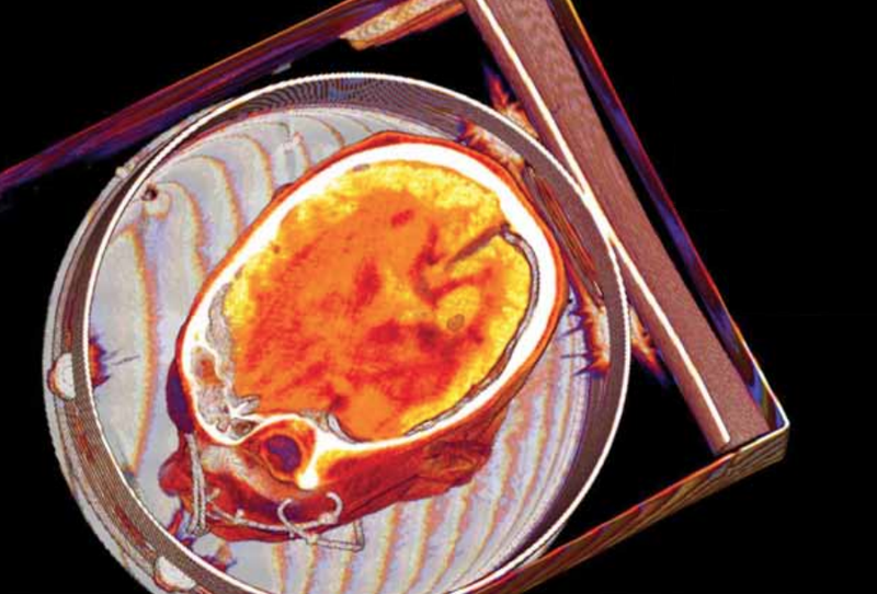 Ein Scan des Gehirns einer jungen Frau nach dem Einfrieren.